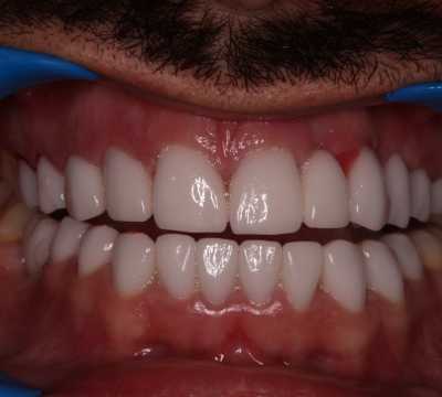 Coroane dentare E-Max