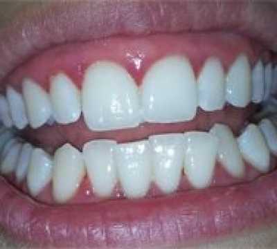 Albirea profesională a dinților