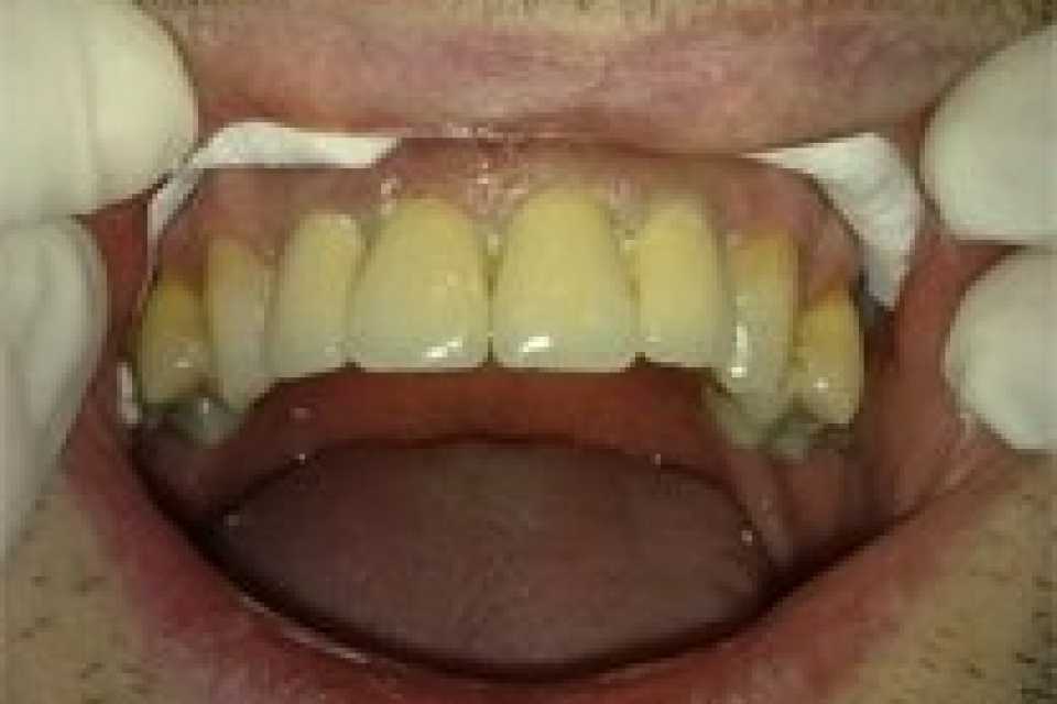 Coroane dentare individuale metalo-ceramice