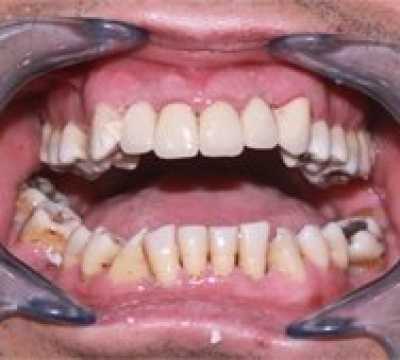 Coroane dentare metalo-ceramice Vita