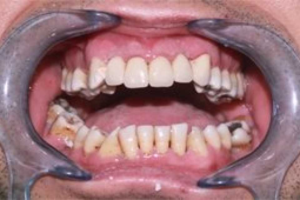 Coroane dentare metalo-ceramice Vita