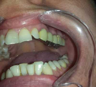 Punte dentară metalo-ceramică