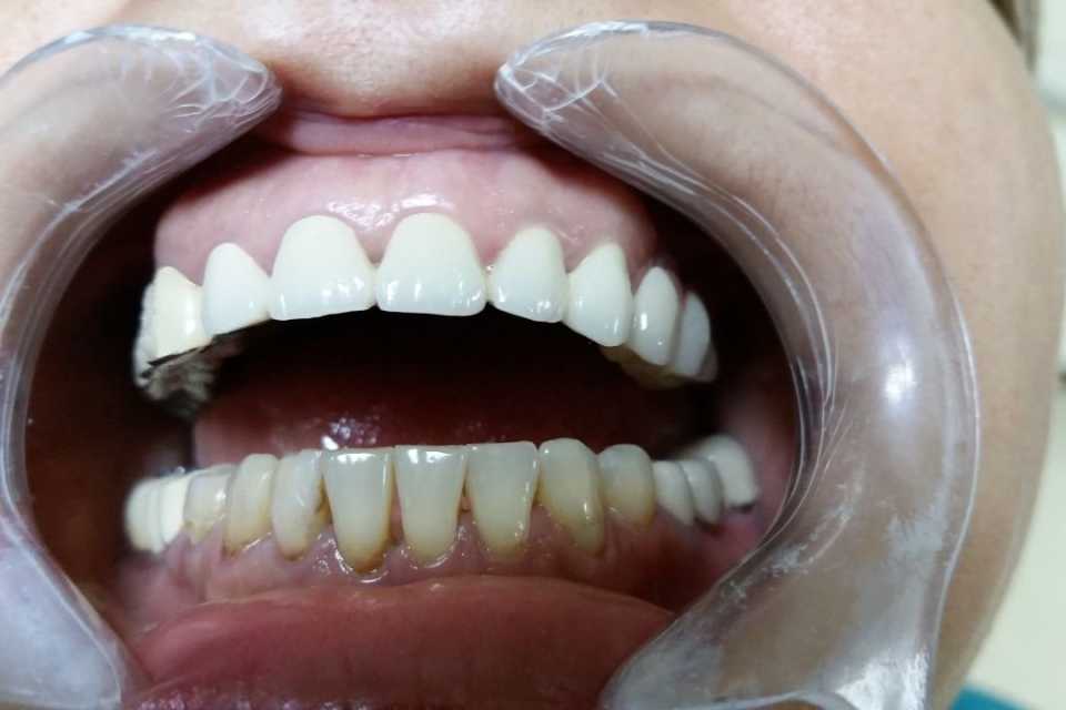 Protezare dinți frontali superiori cu lucrare ceramică