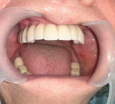 Lucrare dentară protetică fixă din ceramica pe zirconiu