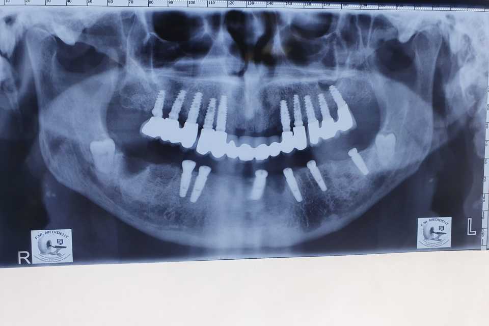 Protezare fixă cu ajutorul implanturilor dentare 3