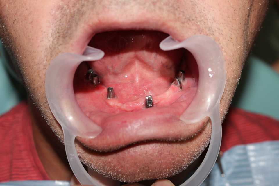 Cazul 44 - Implanturi dentare și proteză metalo-ceramică - 3