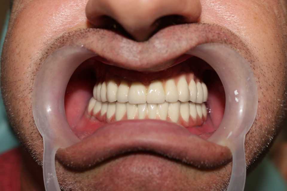 Cazul 44 - Implanturi dentare și proteză metalo-ceramică - 4