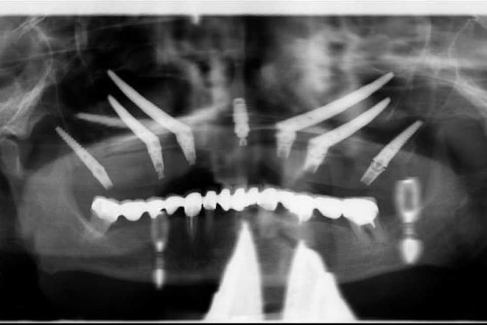 Lucrare dentară protetică fixă din ceramica pe zirconiu 1