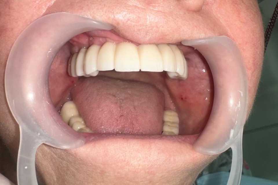 Lucrare dentară protetică fixă din ceramica pe zirconiu 3