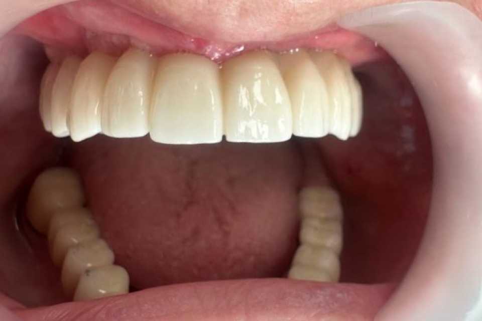 Lucrare dentară protetică fixă din ceramica pe zirconiu 8