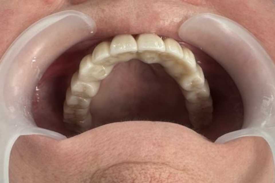 Lucrare dentară protetică fixă din ceramica pe zirconiu 9
