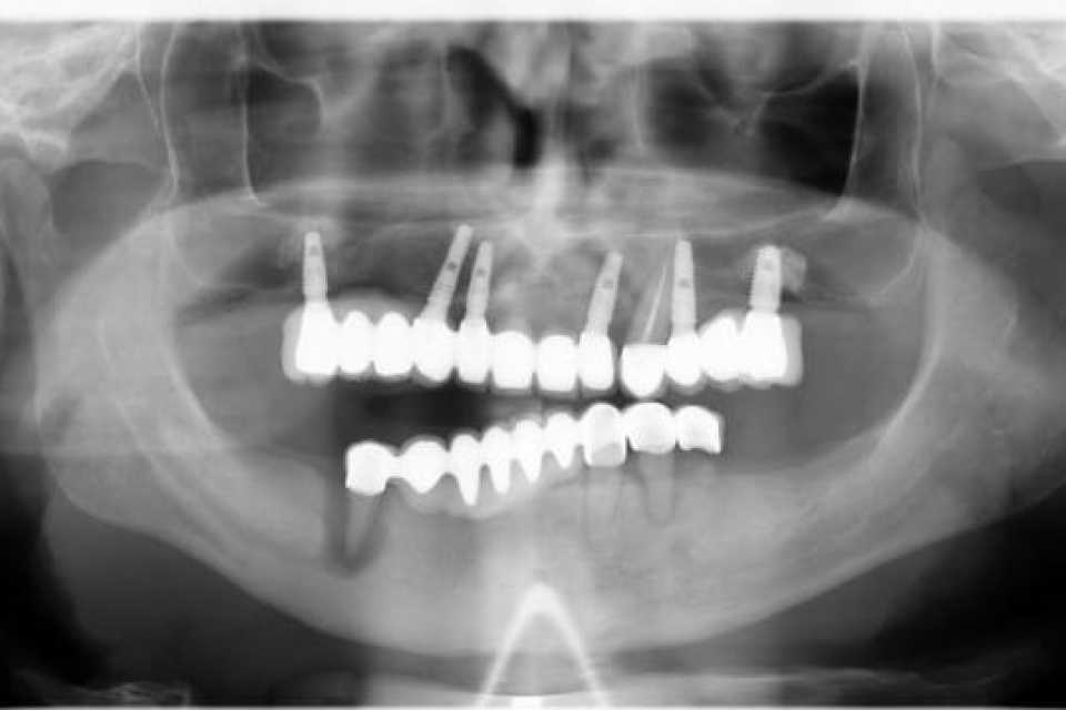 Implanturi dentare Mega Gen Anyridge si elemente ceramice pe zirconiu 1